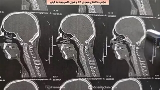 عمل جراحی جااندازی مهره ی C2 و فیوژن اکسی پوت به گردن
