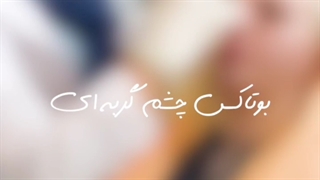 بوتاکس چشم گربه ای