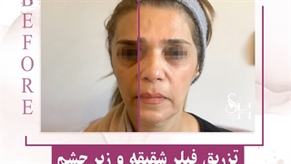 تزریق فیلر زیر چشم و شقیقه
