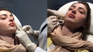 تزریق فیلر زیر چشم