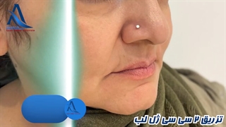 تزریق دو سى سى ژل لب