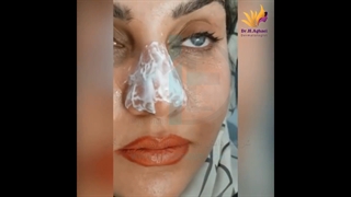 رفع چروک های دور چشم با دستگاه پزشکی پلاسما الکتروسرجیکال
