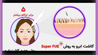 کاشت ابرو تخصصی