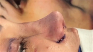 سپتو رینوپلاستی