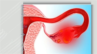 علل برداشتن رحم(هیسترکتومی) را بصورت کامل و جامع از دکتر واحد پور بشنوید