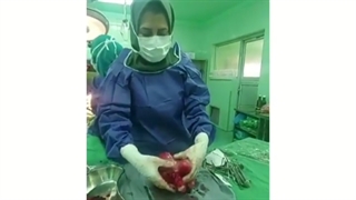 رحم بزرگ و فیبروماتوز