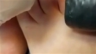 فیلم سوزاندن زگیل پا