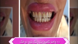 ۲۰ واحد کامپوزیت رنگ بلیچ دو فک