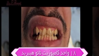کامپوزیت نانو هیبرید دندان