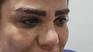 کلینیک کاشت ابرو با لیزر در تهران باکادری مجرب و محیطی آرام