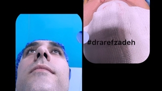 دکتر اسماعیل عارف زاده جراح زیبایی بینی متخصص گوش حلق بینی . قسمت دو از سه . میکرونیدلینگ