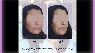 یک ماه بعد از تزریق چربی زاویه سازی صورت