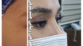 جراحی زیبایی چشم شرقی