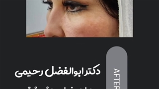 جراحی پلک شرقی