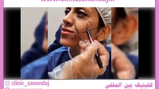 تفاوت نانوفت و تزریق چربی جراحی گوش