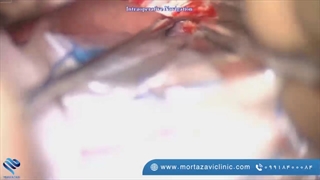 جراحی نورالژی سه قلو