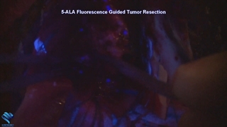 اهمیت ماده فلورسنس 5ala برای کمک به رزکسیون حاشیه مناسب در جراحی گلیوبلاستوم