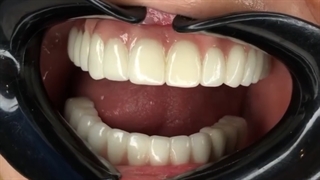 فیلم قبل و بعد از ایمپلنت فک بالا و پایین