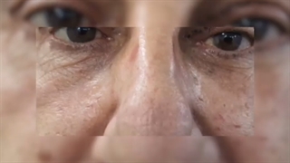 لیفت خفیف ابرو