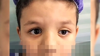 جراحی پیشرفته پتوز مینیمال