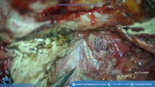 تکنیک جراحی  کوردوم در بصل النخاع