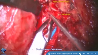 تکنیک جراحی قاعده جمجمه