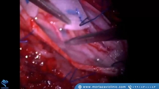 تکنیک مدرن جراحی برای استخراج ناهنجاری غاری