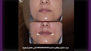 تزریق فیلر پر کردن دندان