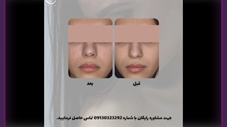 تزریق فیلر و آنزیم بینی