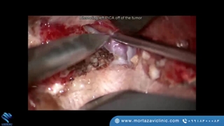 جراحی تومور چسبیده به بطن چهار بصل النخاع