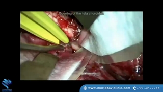 جراحی توموری در میانه ی بصل النخاع