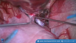 رفع فشار عصب بینایی