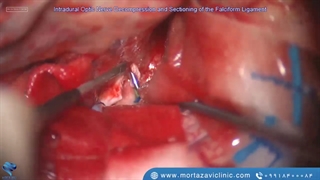 کرانیوتومی جهت خارج کردن تومور مننژیوم