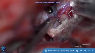 نحوه حرکت در اطراف عصب چشم بدون آسیب رساندن به آن