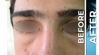 جراحی پلک پایین