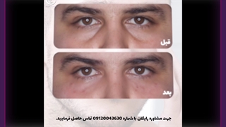 تزریق فیلر تزریق چربی