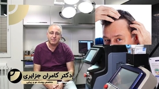 پیوند موی شقیقه