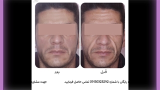 تزریق فیلر تزریق بوتاکس