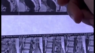 جراحی انحراف ستون فقرات کمر و عود تنگی کانال نخاع کمر در خانم هفتاد ساله با درد شدید هر دو پا و اختلال در حرکت هر دو‌پا