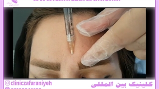 تزریق فیلر در ابرو پریودنتیکس