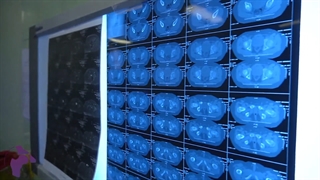 لغزش سر استخوان ران در نوجوان