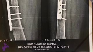 درمان جوش نخوردگی استخوان ران