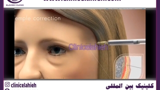 تزریق فیلر تضمینی تهران