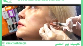 تزریق فیلر برداشتن خال گوشتی