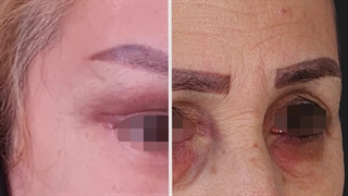 بلفاروپلاستی و لیفت پیشانی و گونه-دکتر سهراب مرادی