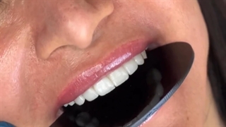 درمان ترکیبی لمینت سرامیکی ایمکس (Emax) و ایمپلنت