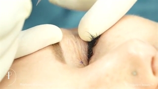 نحوه انجام بلفاروپلاستی