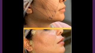 طرز لیفت صورت با نخ