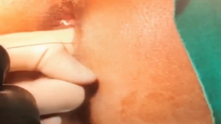 فیلم بوتاکس شقاق مقعد در پرتو کلینیک