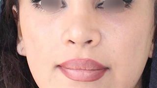 لیفت شقیقه و لیفت گونه-دکتر علی الستی